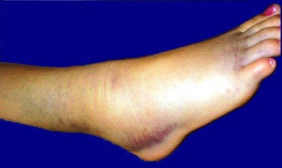 ankle injury2